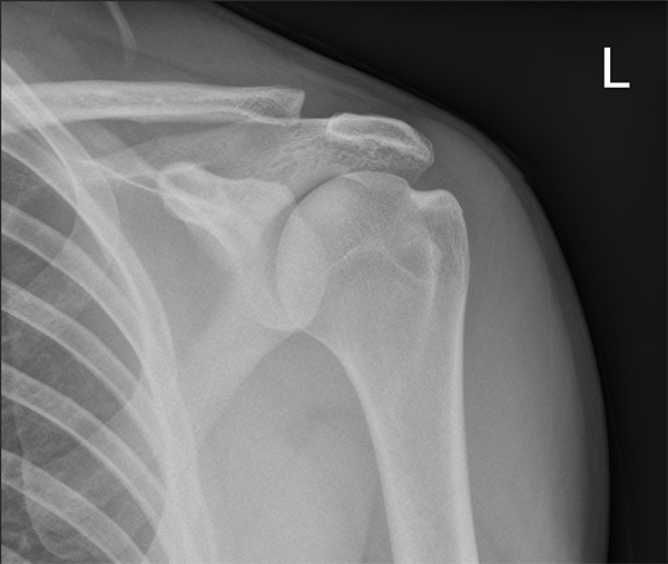Acromioclavicular Joint Injuries (ACJ) - Yorkshire Shoulder Clinic